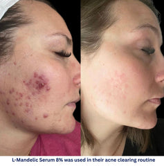L- Mandelic Serum 8%