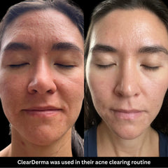 Clearderma Moisturizer