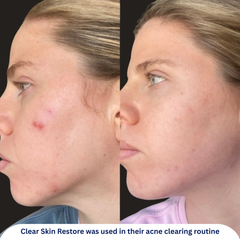 Clear Skin Restore