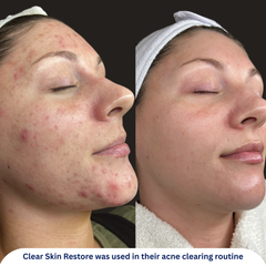 Clear Skin Restore