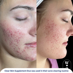 Clear Skin Supplement Duo