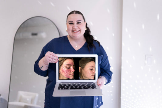 Back to College: Acne Guide for Clearer Skin