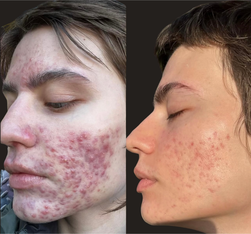 Hormonal Acne