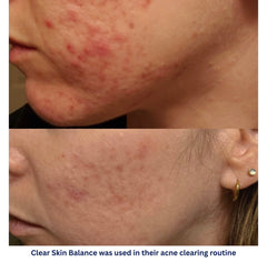 Clear Skin Balance