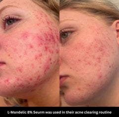 L- Mandelic Serum 8%