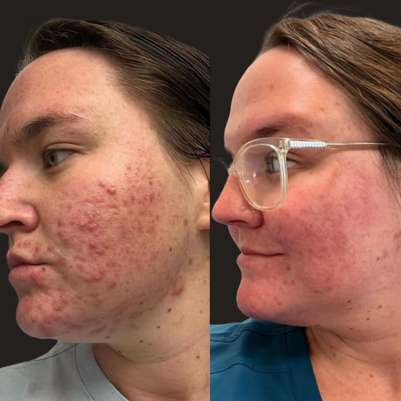 Combination Acne