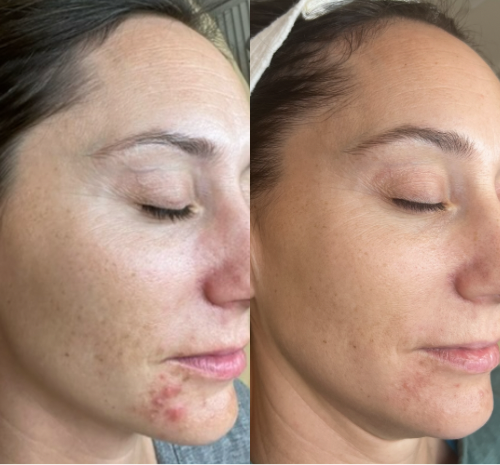 Hormonal Acne