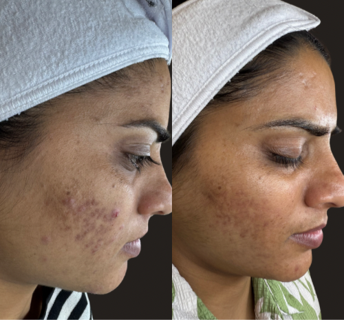 Post-Acne Marks / Scarring