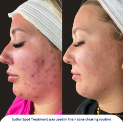 Sulfur Spot Treatment