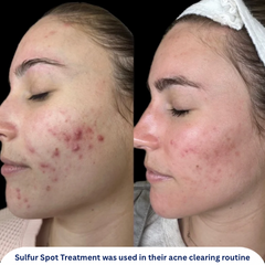Sulfur Spot Treatment