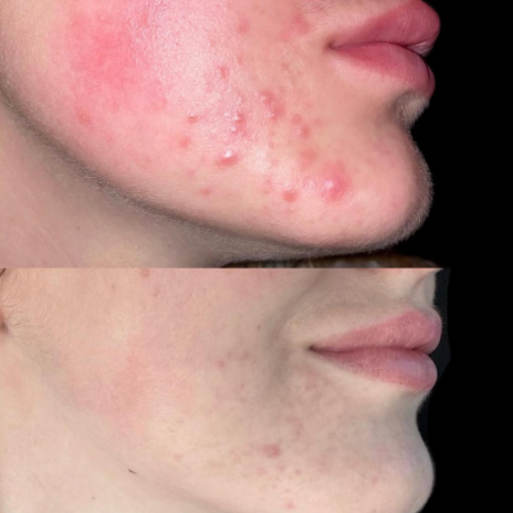 Compromised Skin Barrier