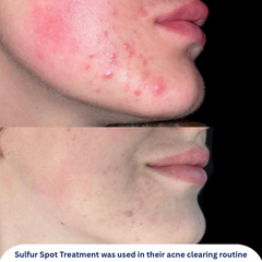 Sulfur Spot Treatment