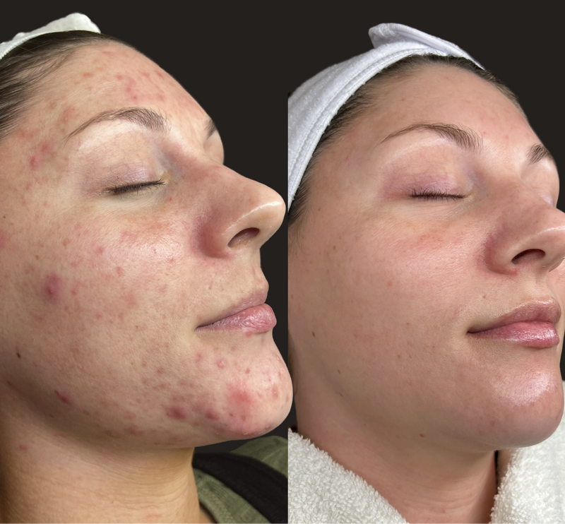 Hormonal Acne