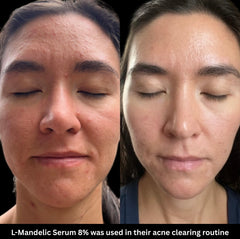L- Mandelic Serum 8%