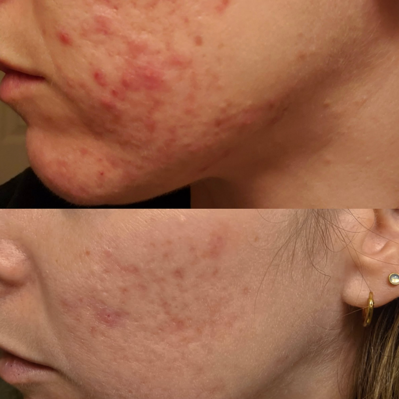 Hormonal Acne