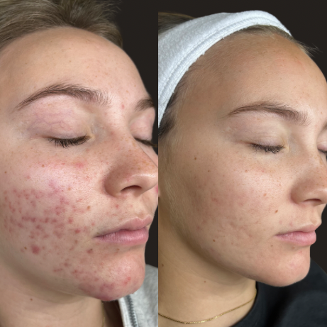 Post-Acne Marks / Scarring