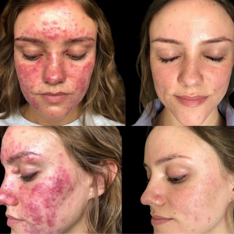 Inflamed Acne