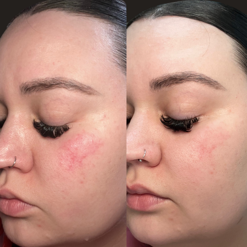 Compromised Skin Barrier