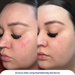 Hydraremedy Gel Serum