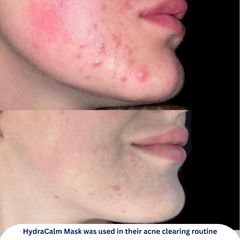 HydraCalm Mask