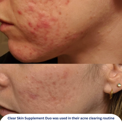 Clear Skin Supplement Duo