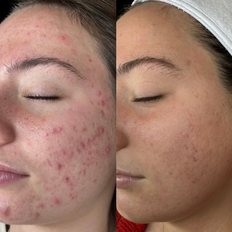 Combination Acne