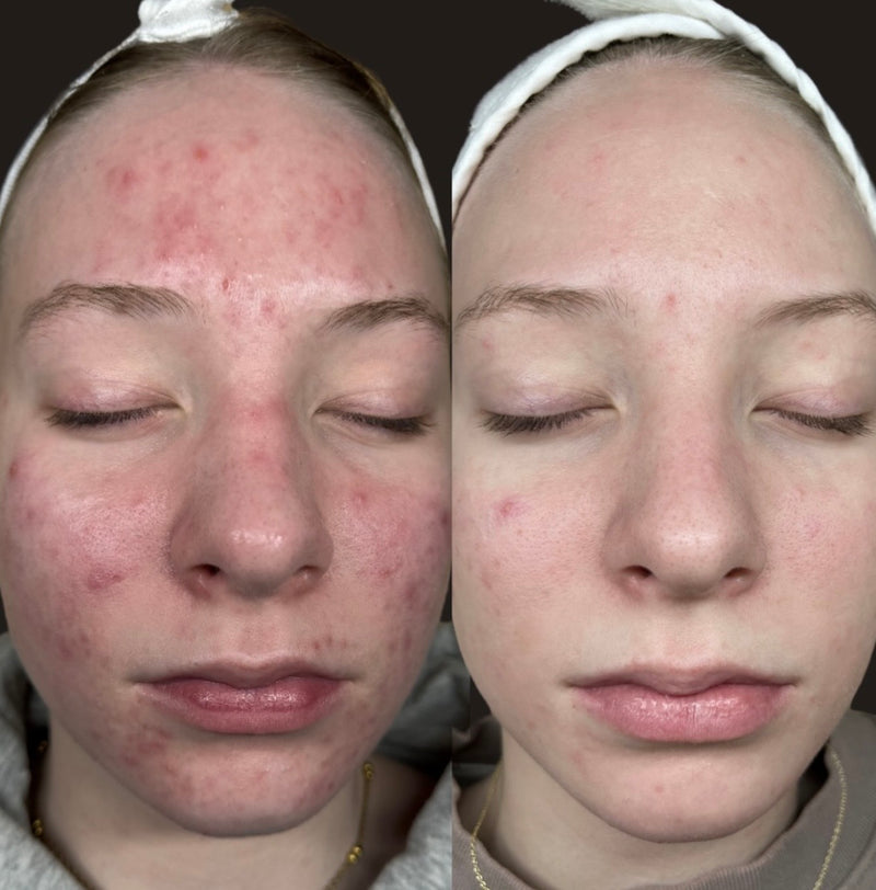 Compromised Skin Barrier