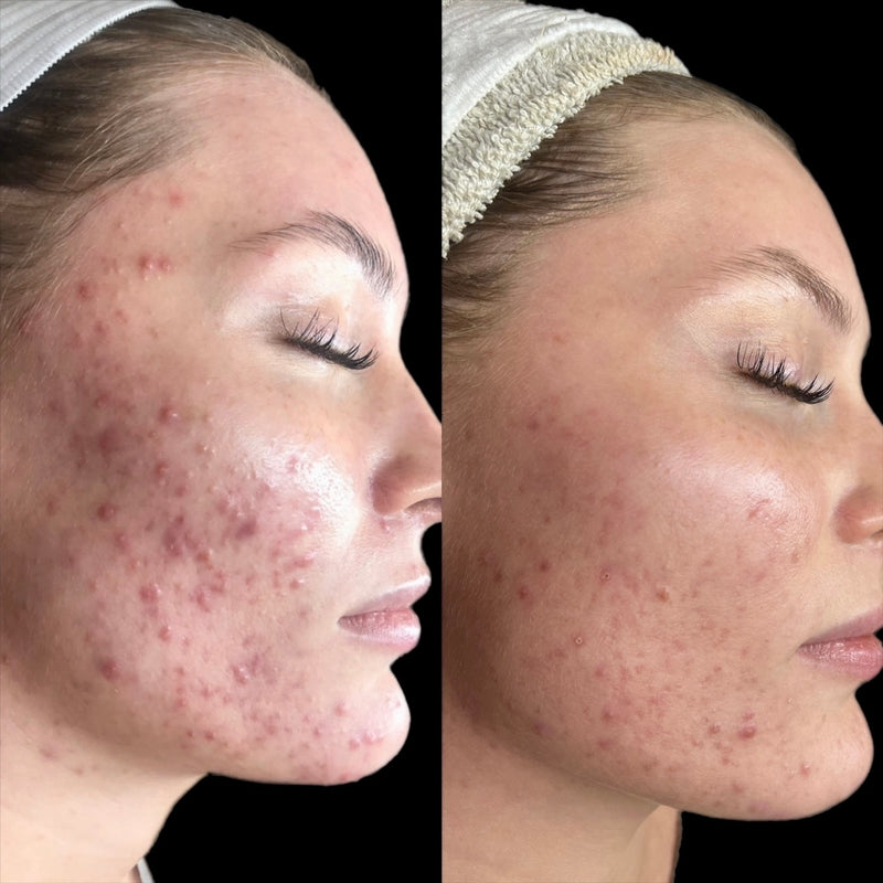 Combination Acne