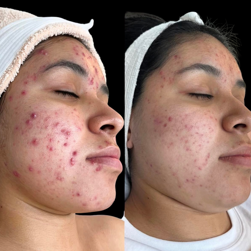 Inflamed Acne