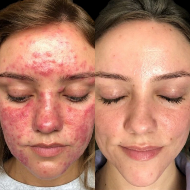 Inflamed Acne